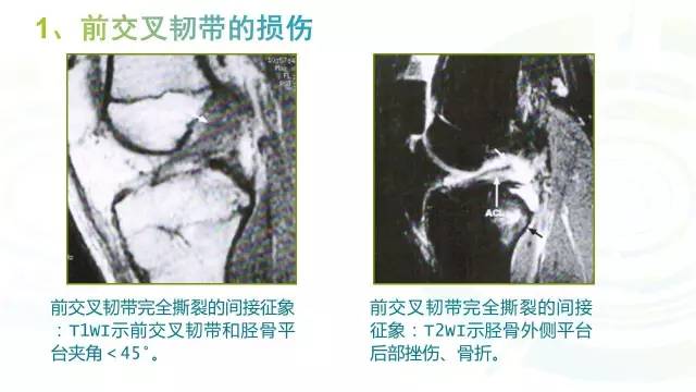 【PPT】6种膝关节周围韧带损伤，如何用MR诊断？