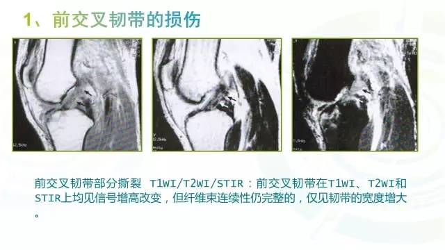 【PPT】6种膝关节周围韧带损伤，如何用MR诊断？