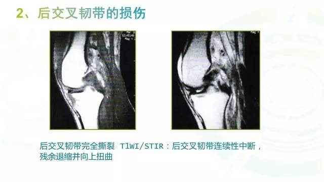 【PPT】6种膝关节周围韧带损伤，如何用MR诊断？
