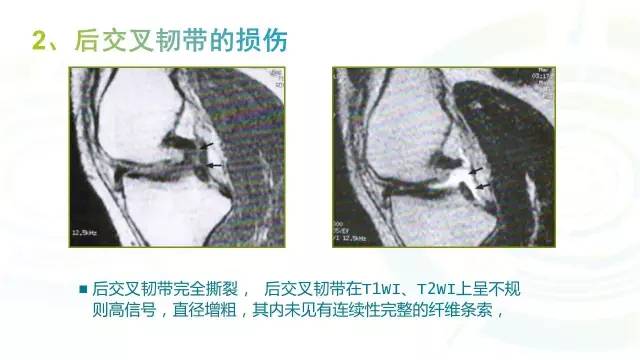【PPT】6种膝关节周围韧带损伤，如何用MR诊断？