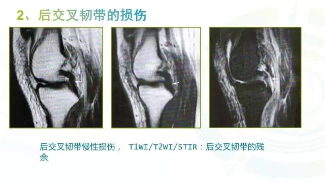 【PPT】6种膝关节周围韧带损伤，如何用MR诊断？