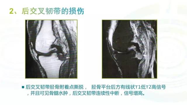 【PPT】6种膝关节周围韧带损伤，如何用MR诊断？