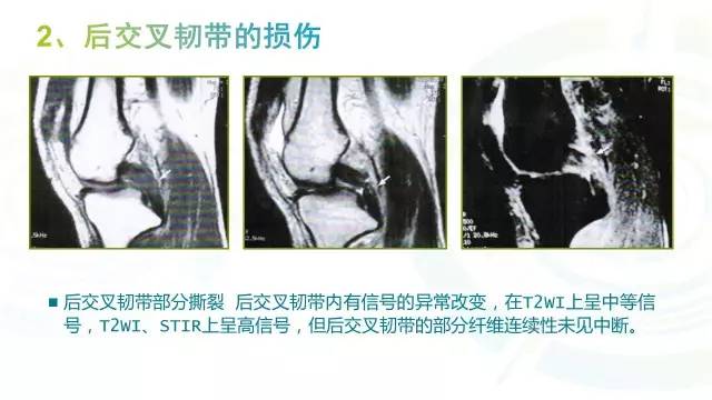 【PPT】6种膝关节周围韧带损伤，如何用MR诊断？