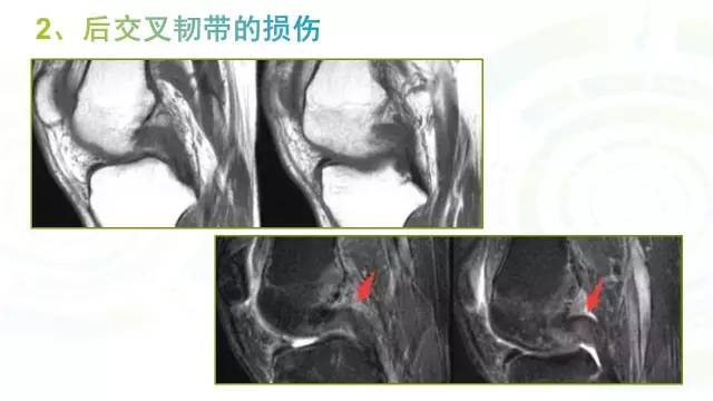 【PPT】6种膝关节周围韧带损伤，如何用MR诊断？