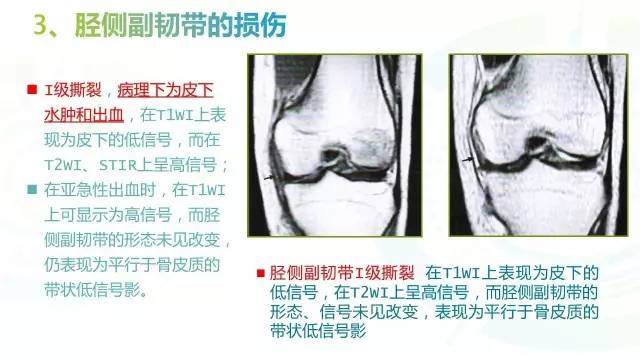 【PPT】6种膝关节周围韧带损伤，如何用MR诊断？