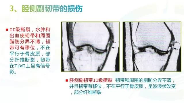 【PPT】6种膝关节周围韧带损伤，如何用MR诊断？