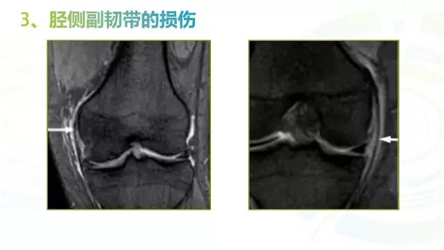 【PPT】6种膝关节周围韧带损伤，如何用MR诊断？