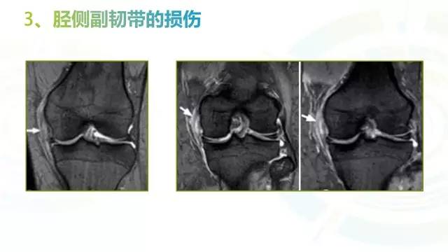 【PPT】6种膝关节周围韧带损伤，如何用MR诊断？