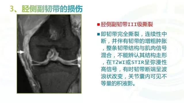 【PPT】6种膝关节周围韧带损伤，如何用MR诊断？
