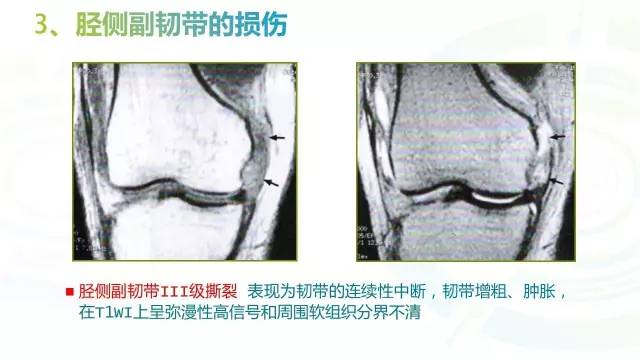 【PPT】6种膝关节周围韧带损伤，如何用MR诊断？