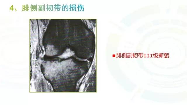 【PPT】6种膝关节周围韧带损伤，如何用MR诊断？