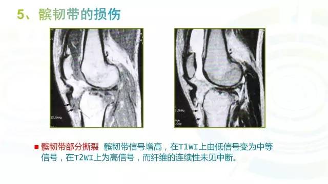 【PPT】6种膝关节周围韧带损伤，如何用MR诊断？