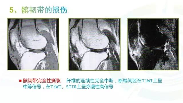 【PPT】6种膝关节周围韧带损伤，如何用MR诊断？