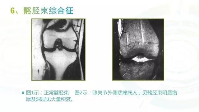 【PPT】6种膝关节周围韧带损伤，如何用MR诊断？