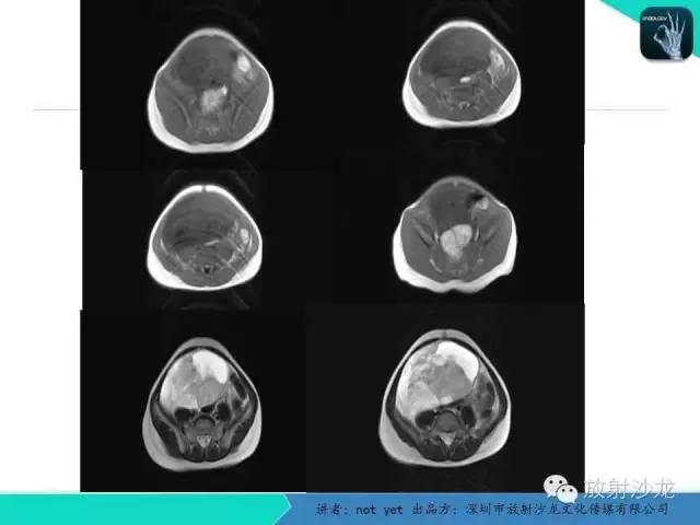 【病例】盆腔未成熟畸胎瘤1例CT影像表现