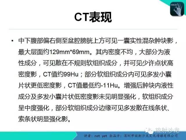 【病例】盆腔未成熟畸胎瘤1例CT影像表现