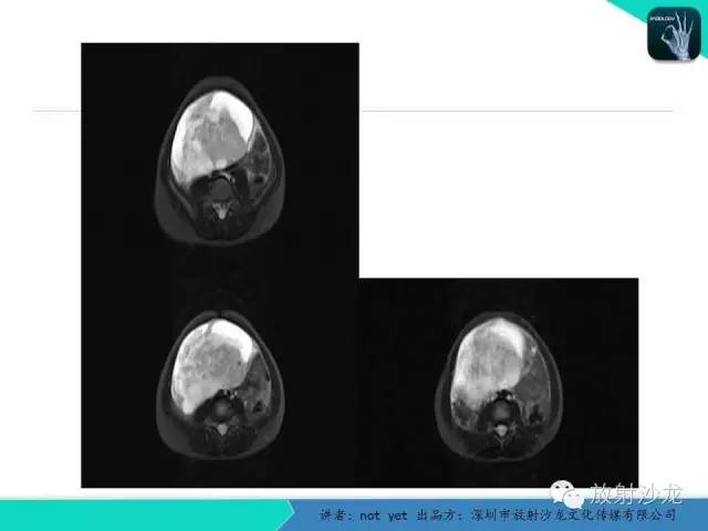 【病例】盆腔未成熟畸胎瘤1例CT影像表现
