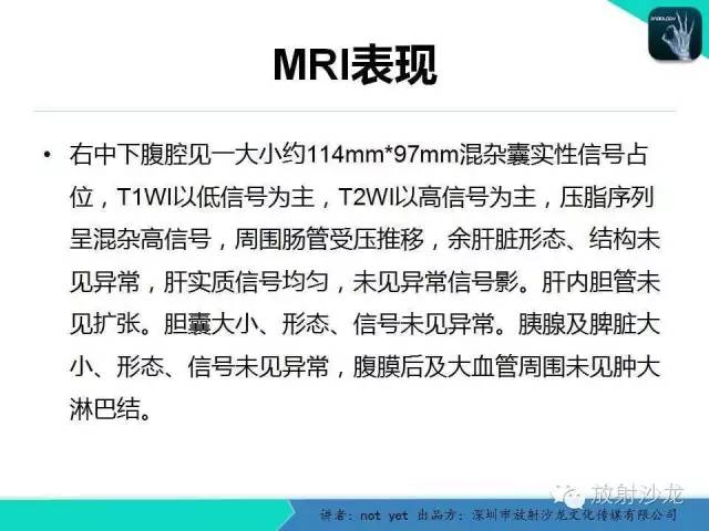 【病例】盆腔未成熟畸胎瘤1例CT影像表现