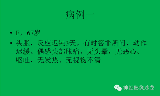 【病例】脑胶质瘤两例MR影像表现