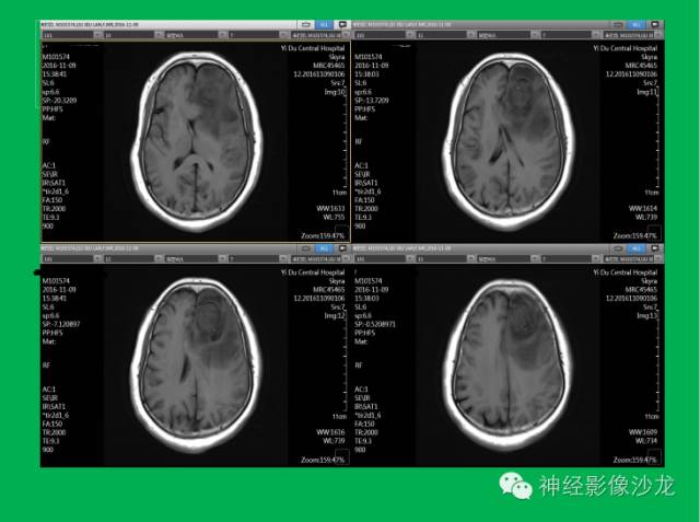 【病例】脑胶质瘤两例MR影像表现