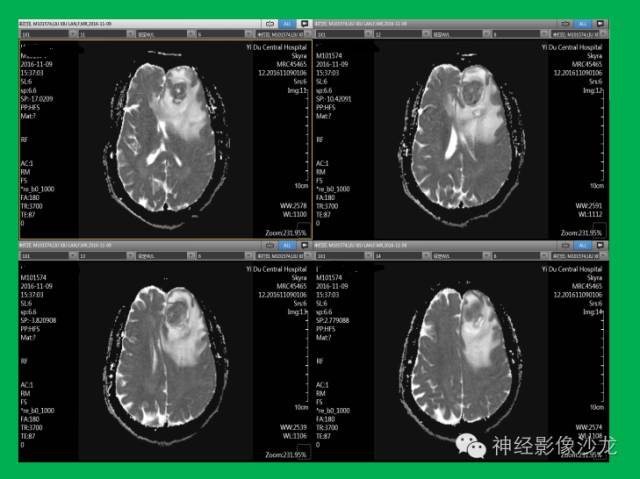 【病例】脑胶质瘤两例MR影像表现
