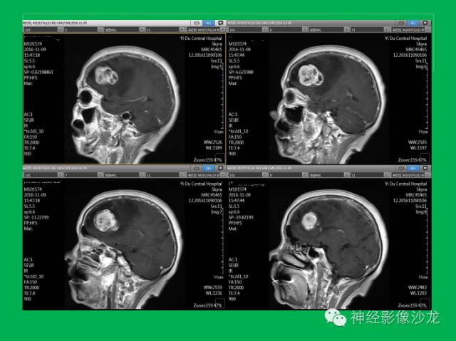 【病例】脑胶质瘤两例MR影像表现