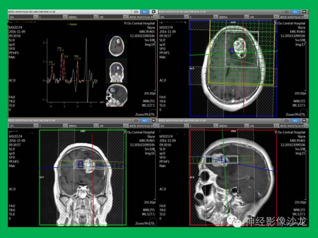 【病例】脑胶质瘤两例MR影像表现