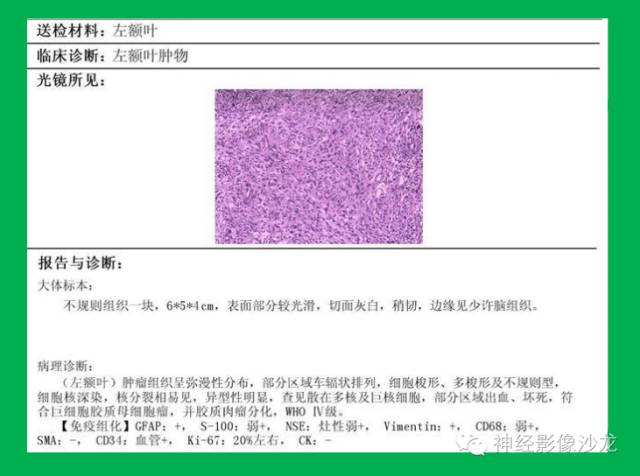 【病例】脑胶质瘤两例MR影像表现