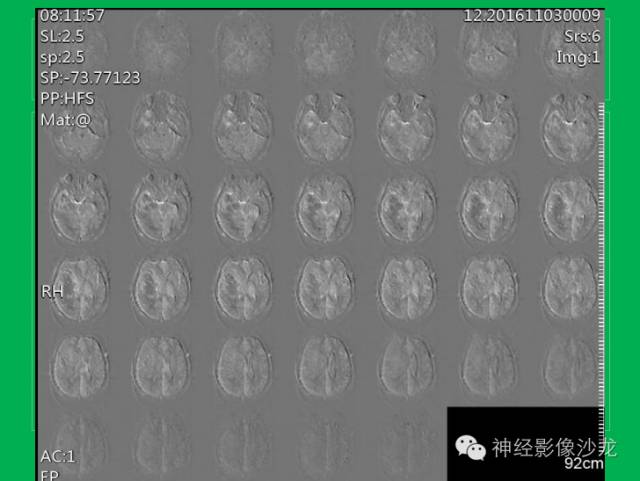 【病例】脑胶质瘤两例MR影像表现