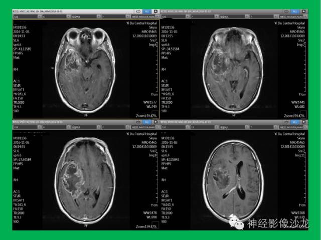 【病例】脑胶质瘤两例MR影像表现