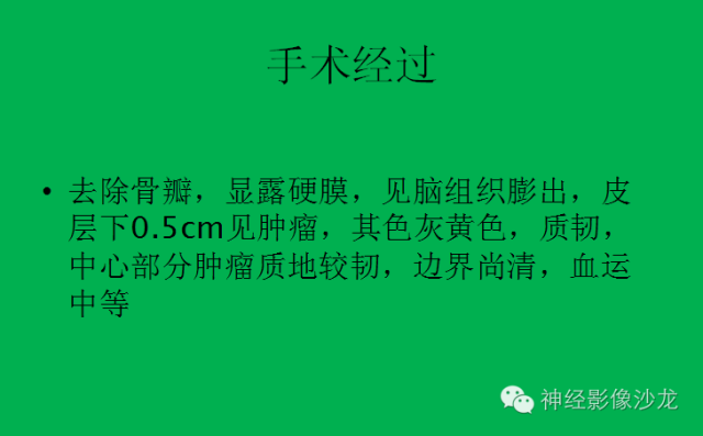 【病例】脑胶质瘤两例MR影像表现