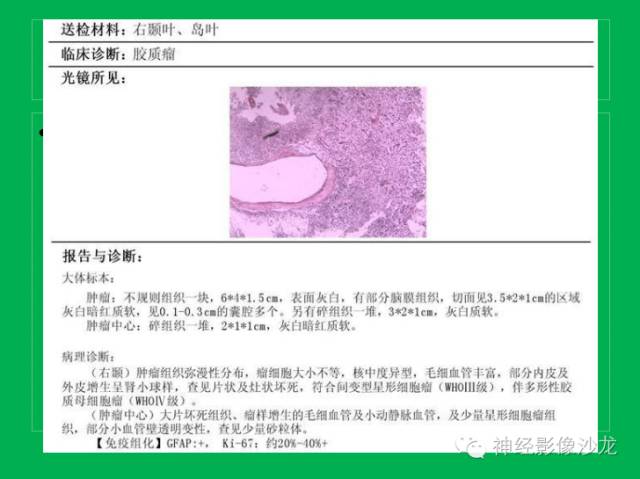 【病例】脑胶质瘤两例MR影像表现