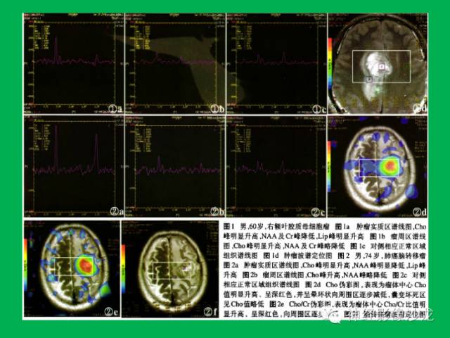 【病例】脑胶质瘤两例MR影像表现