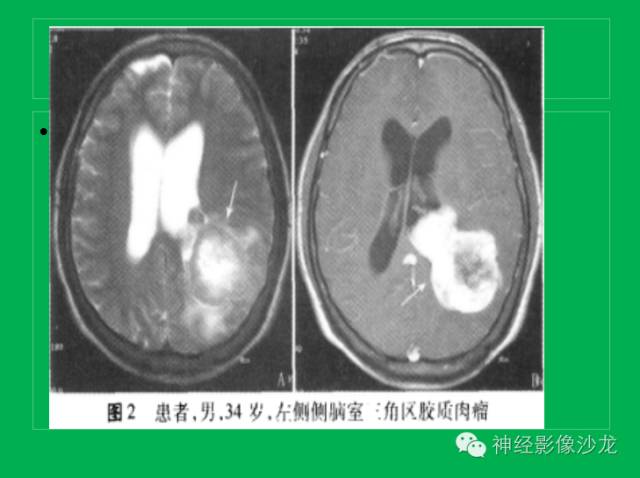 【病例】脑胶质瘤两例MR影像表现