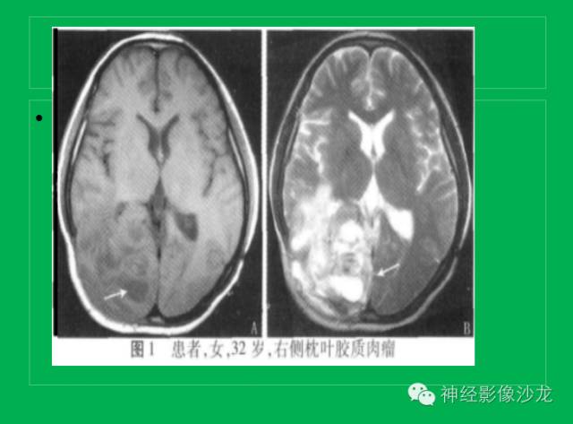 【病例】脑胶质瘤两例MR影像表现
