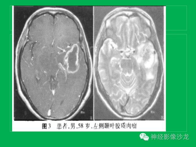 【病例】脑胶质瘤两例MR影像表现