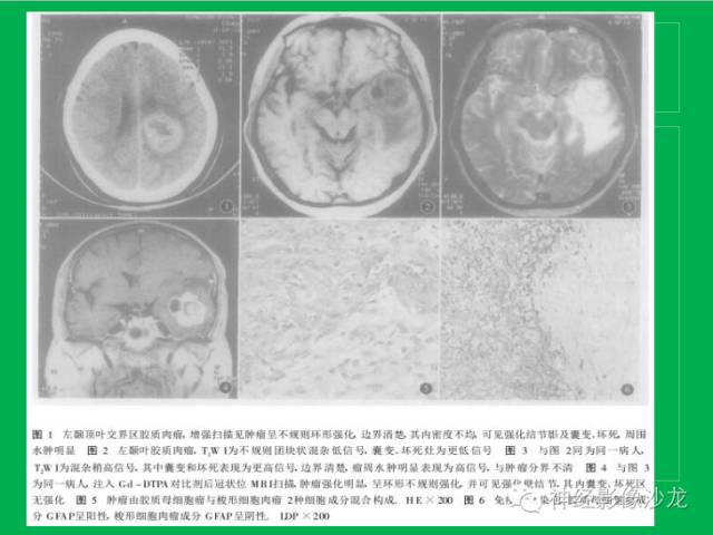 【病例】脑胶质瘤两例MR影像表现