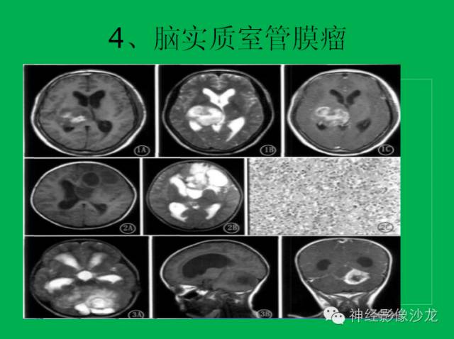 【病例】脑胶质瘤两例MR影像表现