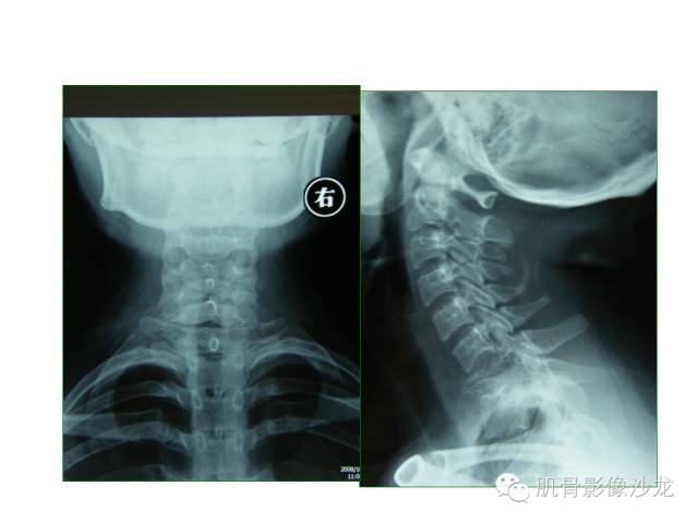 【病例】椎体软骨母细胞瘤一例X线CT及MR影像讨论 【病例】椎体软骨母细胞瘤一例X线CT及MR影像讨论