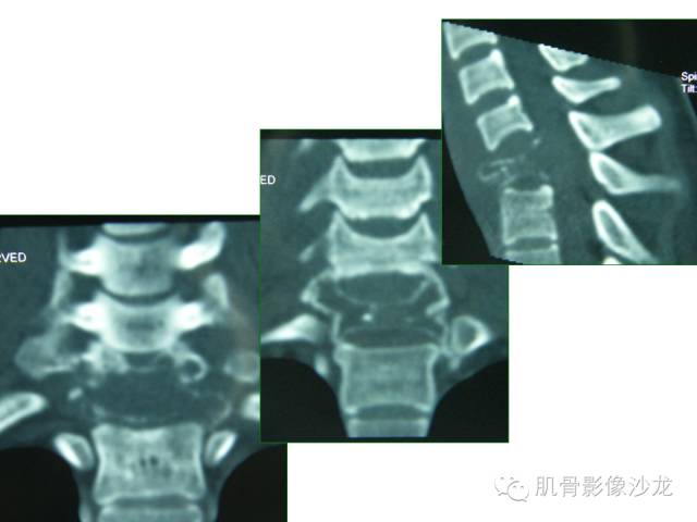 【病例】椎体软骨母细胞瘤一例X线CT及MR影像讨论 【病例】椎体软骨母细胞瘤一例X线CT及MR影像讨论