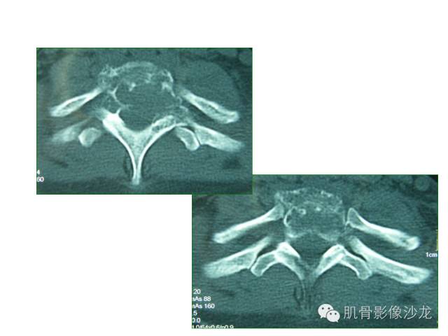 【病例】椎体软骨母细胞瘤一例X线CT及MR影像讨论 【病例】椎体软骨母细胞瘤一例X线CT及MR影像讨论