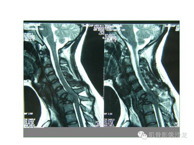 【病例】椎体软骨母细胞瘤一例X线CT及MR影像讨论 【病例】椎体软骨母细胞瘤一例X线CT及MR影像讨论