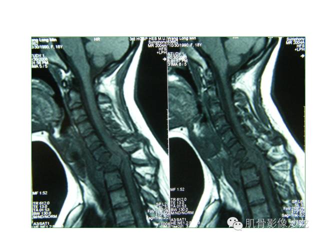【病例】椎体软骨母细胞瘤一例X线CT及MR影像讨论 【病例】椎体软骨母细胞瘤一例X线CT及MR影像讨论