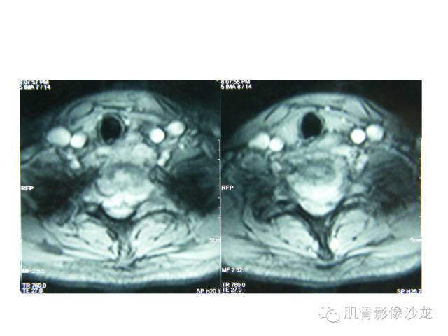 【病例】椎体软骨母细胞瘤一例X线CT及MR影像讨论 【病例】椎体软骨母细胞瘤一例X线CT及MR影像讨论