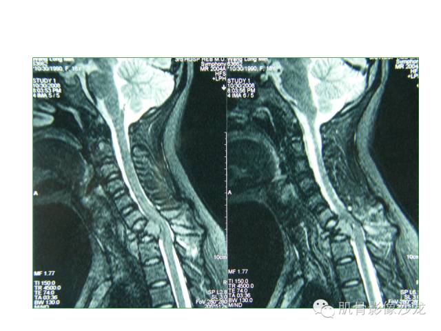 【病例】椎体软骨母细胞瘤一例X线CT及MR影像讨论 【病例】椎体软骨母细胞瘤一例X线CT及MR影像讨论