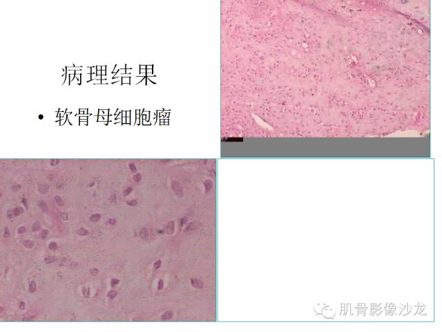 【病例】椎体软骨母细胞瘤一例X线CT及MR影像讨论 【病例】椎体软骨母细胞瘤一例X线CT及MR影像讨论