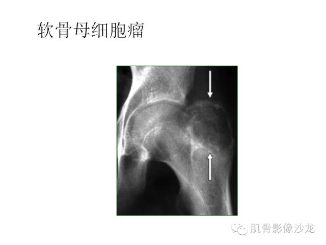 【病例】椎体软骨母细胞瘤一例X线CT及MR影像讨论 【病例】椎体软骨母细胞瘤一例X线CT及MR影像讨论