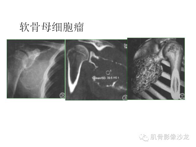 【病例】椎体软骨母细胞瘤一例X线CT及MR影像讨论 【病例】椎体软骨母细胞瘤一例X线CT及MR影像讨论