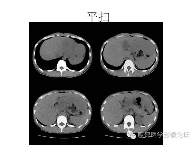 【病例】肝细胞型肝癌1例CT影像表现