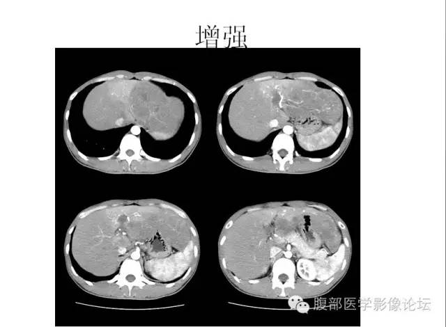 【病例】肝细胞型肝癌1例CT影像表现